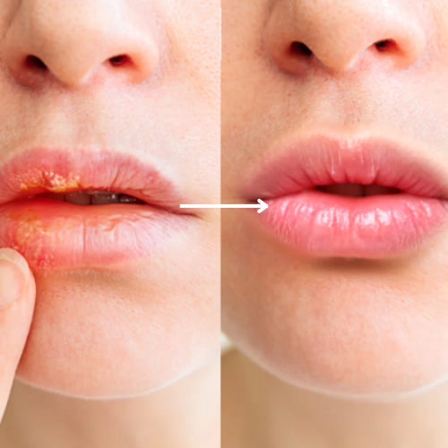 Oral&Targeted Red Light Therapy Device, Cold Sore Treatment for Lips, Canker Sore Treatment Inside