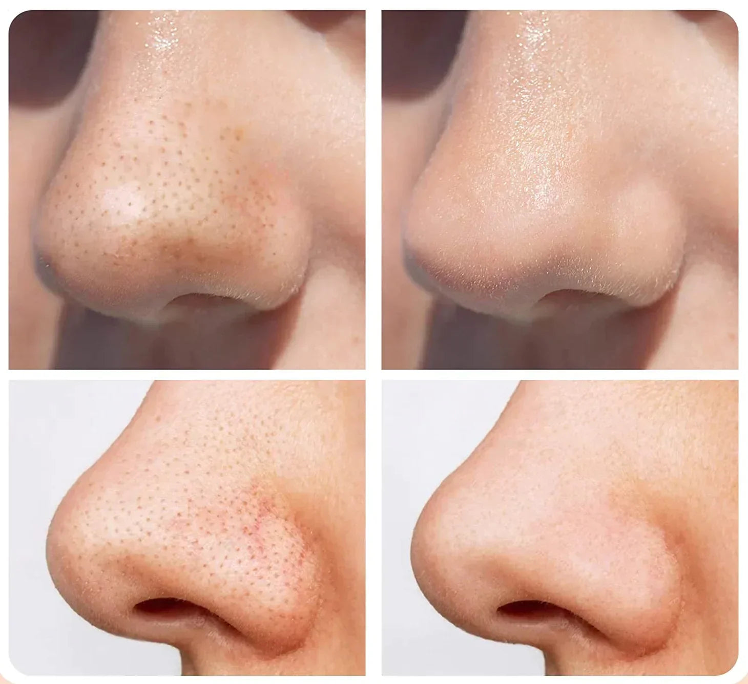 Comforth MicroDerm - Personal Diamond Grinding - diamond resurfacing/blackhead remover