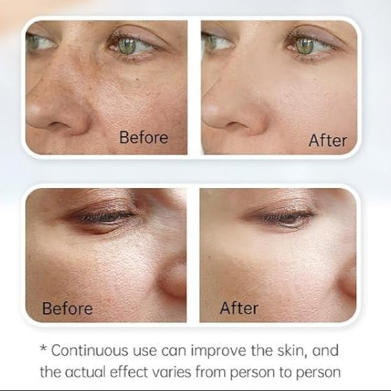 Pokročilý microneedlingový pero Hydra H3