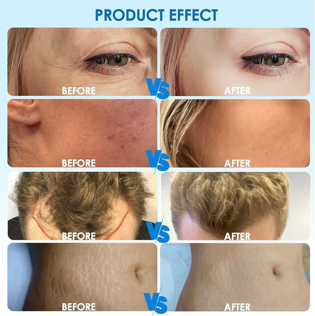 Pokročilý microneedlingový pero Hydra H3