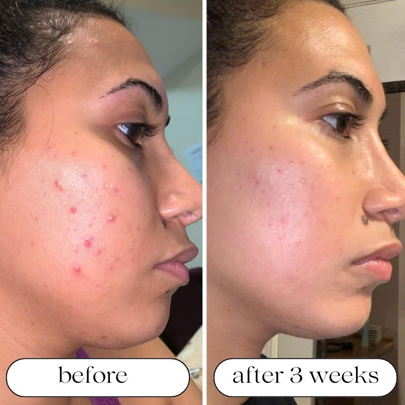 Medical Grade LED Light Therapy Machine