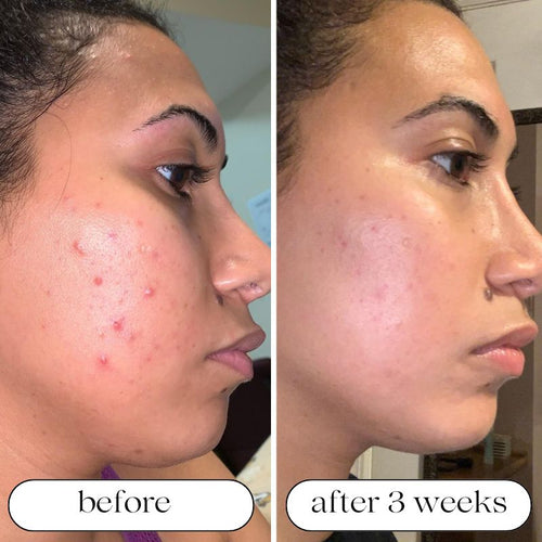 Medical Grade LED Light Therapy Machine