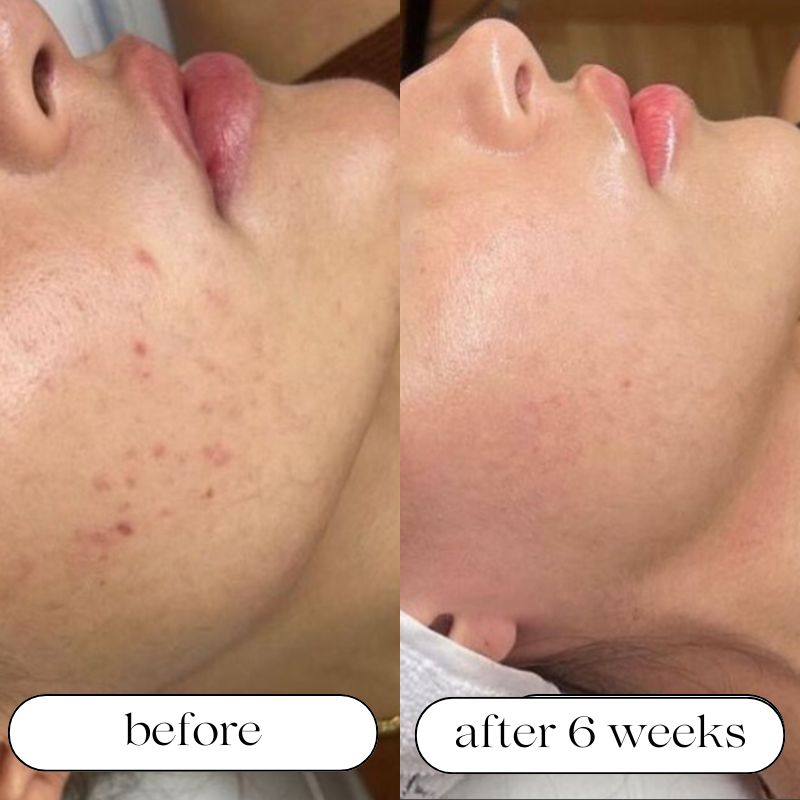 Medical Grade Infrared & Red Light Panel