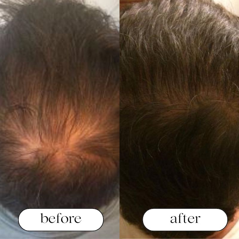 Red Light Therapy Cap for Hair Growth