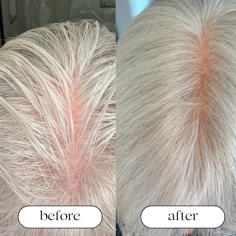 Rødt lys terapi lue for hårvekst