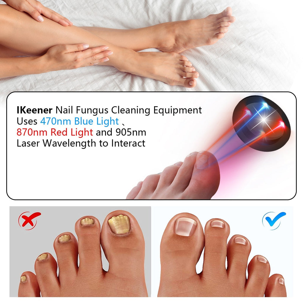 Nail Fungus Laser Treatment Device