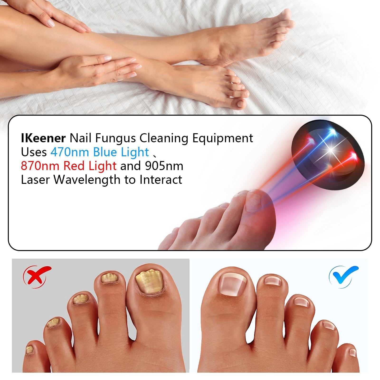 Nail Fungus Laser Treatment Device