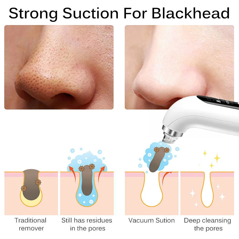 Upgraded Blackhead Remover Pore Vacuum