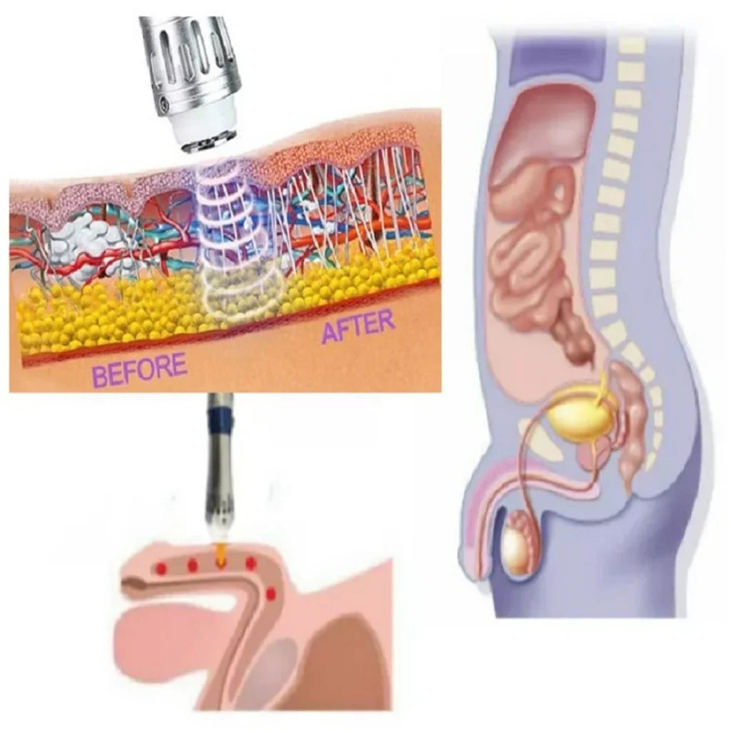 Portable Extracorporeal Shockwave Therapy Device for ED
